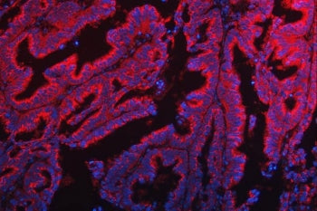 Immunofluorescent staining of FFPE human ovarian cancer tissue with TTC7B antibody (red) and DAPI nu
