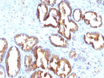 IHC staining of FFPE human prostate carcinoma with PSAP antibody (clone PASE/4LJ). HIER: boil tissue
