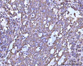 IHC staining of FFPE human lung adenocarcinoma tissue with RPS14 antibody. HIER: boil tissue section