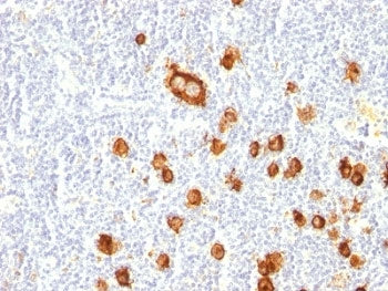 IHC: Formalin-fixed, paraffin-embedded human Hodgkin's lymphoma stained with CD15 antibody (clone FU