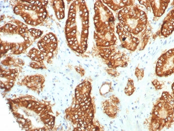 IHC staining of FFPE human prostate carcinoma tissue with TROP2 antibody (clone TACSTD2/7349R). HIER