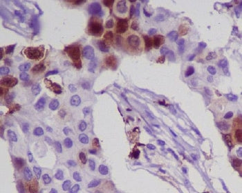 IHC staining of FFPE human breast cancer with S100A8 antibody. HIER: boil tissue sections in pH6, 10