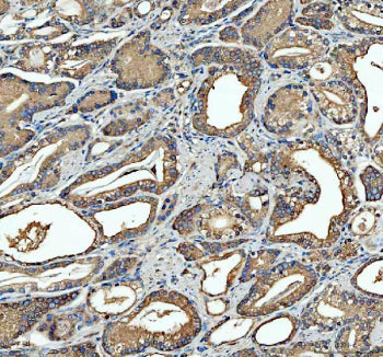 Immunohistochemical staining of FFPE human prostate cancer tissue with SGSH antibody, HRP-secondary 