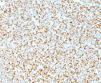 IHC testing of human mantle cell lymphoma stained with Cyclin D1 antibody. Nuclear staining of tumor