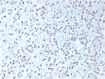 IHC testing of FFPE human mesothelioma tissue with recombinant WT1 antibody (clone WT1/1434R). HIER:
