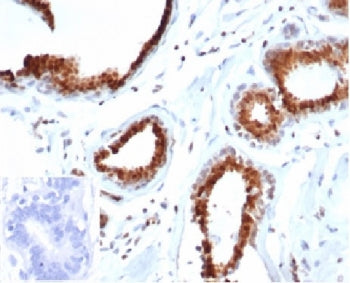 IHC staining of FFPE human breast carcinoma tissue with recombinant p27Kip1 antibody (clone rKIP1/13
