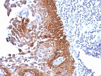 IHC: Formalin-fixed, paraffin-embedded human cervical carcinoma stained with Cytokeratin 18 antibody