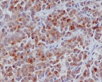 IHC staining of FFPE human colon cancer with CCNB1 antibody. HIER: boil tissue sections in pH6, 10mM