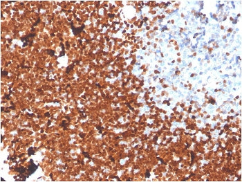 IHC staining of FFPE human thymus with TdT antibody. HIER: boil tissue sections in pH 9 10mM Tris wi