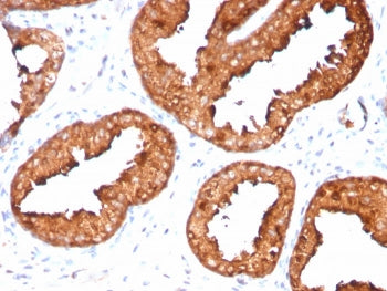 IHC staining of FFPE human prostate carcinoma with recombinant PSA antibody (clone KLK3/4551R). HIER