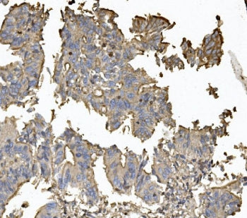 IHC staining of FFPE human rectal cancer with CLDN5 antibody. HIER: boil tissue sections in pH8 EDTA