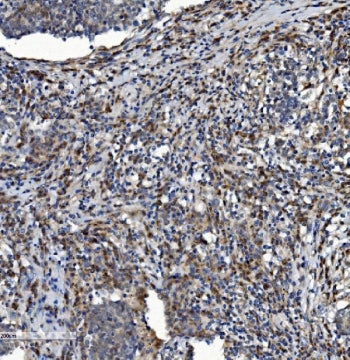 IHC staining of FFPE human lung cancer with NDUFB2 antibody. HIER: boil tissue sections in pH8 EDTA 