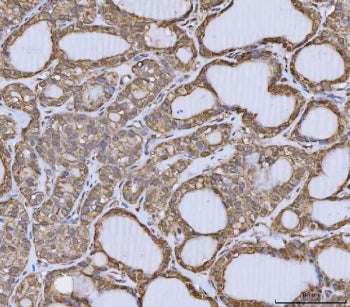 IHC staining of FFPE human thyroid cancer tissue with ANXA10 antibody. HIER: boil tissue sections in