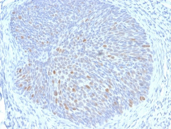 IHC staining of FFPE human cervix with HPV16 E1/E4 antibody. HIER: boil tissue sections in pH 9 10mM