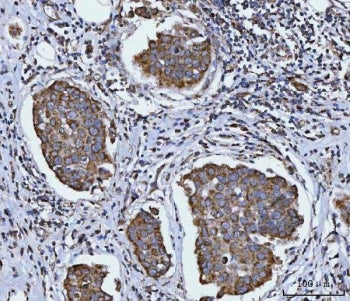 IHC staining of FFPE human breast cancer tissue with Sirtuin 5 antibody. HIER: boil tissue sections 
