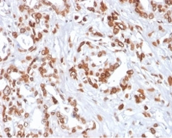 IHC staining of FFPE human breast carcinoma tissue with TCF4 antibody (clone TCF4/2252) at 2ug/ml. H
