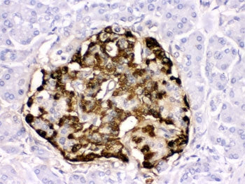 IHC testing of human pancreatic cancer tissue with GLP-1 antibody. HIER: Boil the paraffin sections 