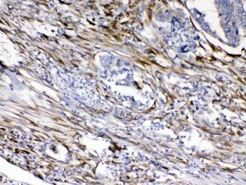 IHC testing of FFPE human intestinal cancer tissue with Cytoglobin antibody at 1ug/ml. Required HIER