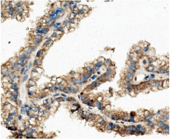 IHC staining of FFPE human renal cancer with CKAP5 antibody. HIER: boil tissue sections in pH8 EDTA 