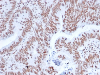 IHC staining of FFPE human colon carcinoma with NRF1 antibody. HIER: boil tissue sections in pH 9 10
