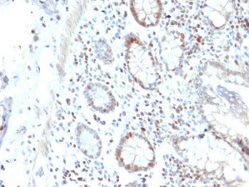 IHC staining of FFPE human colon carcinoma with RAD51 antibody. HIER: boil tissue sections in pH6, 1