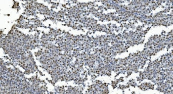 IHC staining of FFPE human testis cancer with GLRX2 antibody. HIER: boil tissue sections in pH8 EDTA