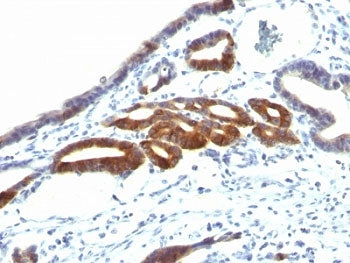 IHC: Formalin-fixed, paraffin-embedded human gastric carcinoma stained with anti-MUC6 antibody (SPM5