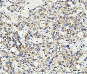 IHC staining of FFPE human liver cancer with ABCB4 antibody. HIER: boil tissue sections in pH8 EDTA 