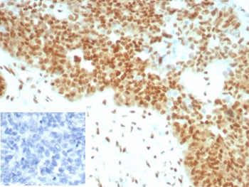 IHC staining of FFPE human ovarian cancer tissue with recombinant E2F4 antibody (clone E2F4/8931R). 