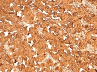 IHC staining of FFPE human pituitary tumor tissue with recombinant ACTH antibody (clone rCLIP4278). 