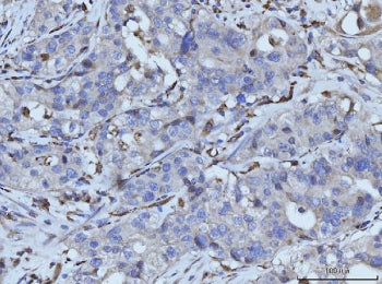IHC staining of FFPE human appendiceal adenocarcinoma tissue with PLD3 antibody. HIER: boil tissue s