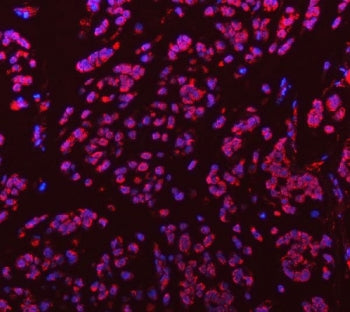 Immunofluorescent staining of FFPE human breast cancer tissue with Sm-D3 antibody (red) and DAPI nuc