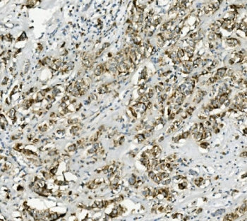 IHC staining of FFPE human breast cancer with PCK2 antibody. HIER: boil tissue sections in pH8 EDTA 