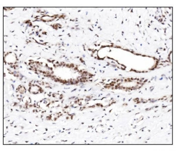 IHC staining of FFPE human breast cancer tissue with SUMO2/3 antibody. HIER: boil tissue sections in