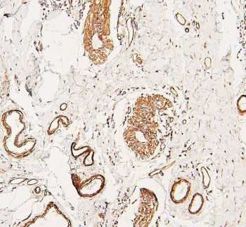 IHC staining of FFPE human breast cancer with LPP antibody. HIER: boil tissue sections in pH6, 10mM 