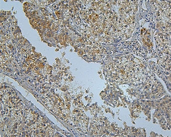 IHC staining of FFPE human liver cancer with PCSK9 antibody. HIER: boil tissue sections in pH8 EDTA 