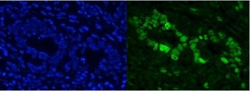 Immunofluorescent staining of FFPE human rectal cancer with CBX8 antibody. HIER: boil tissue section