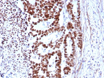 IHC staining of FFPE human colon carcinoma tissue with TP53 antibody (clone rTP53/8579). HIER: boil 