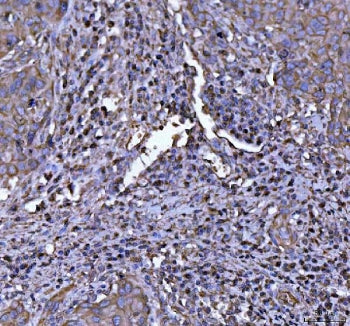 IHC staining of FFPE human squamous cell cervical carcinoma tissue with NLRP3 antibody. HIER: boil t