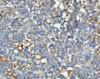 IHC staining of FFPE human breast cancer tissue with Thrombospondin-3 antibody. HIER: boil tissue se