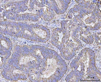 IHC staining of FFPE human colorectal adenocarcinoma tissue with Renin antibody. HIER: boil tissue s
