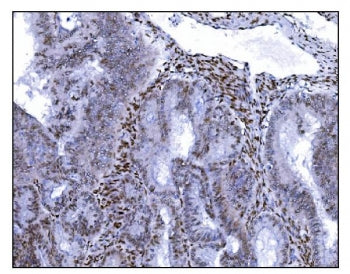 IHC staining of FFPE human endometrial cancer tissue with SRF antibody. HIER: boil tissue sections i