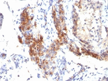 IHC: Formalin-fixed, paraffin-embedded human testicular carcinoma stained with FOXP3 antibody (SPM57