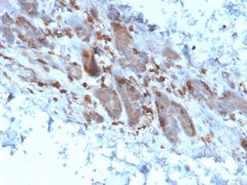 IHC staining of FFPE human colon carcinoma with IL-1 alpha antibody (clone IL1A/3982). HIER: boil ti