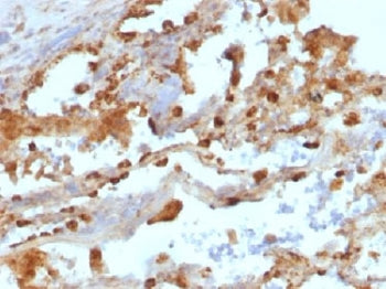 IHC: Formalin-fixed, paraffin-embedded human lung carcinoma stained with Keratin 8 antibody (KRT8/80