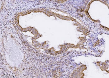 IHC staining of FFPE human ovarian carcinoma tissue with PMPCB antibody. HIER: boil tissue sections 