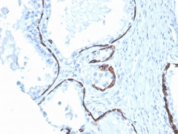 IHC staining of FFPE human prostate with Cytokeratin 5/6 antibody (clone KRT5.6/4866). HIER: boil ti