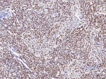 IHC staining of FFPE human ovarian serous adenocarcinoma tissue with RBFOX2 antibody. HIER: boil tis