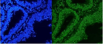 Immunofluorescent staining of FFPE human rectal cancer with hnRNP A1 antibody (green) and DAPI nucle
