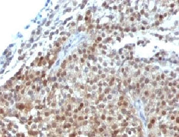 IHC: Formalin-fixed, paraffin-embedded human bladder carcinoma stained with p21 antibody cocktail (c